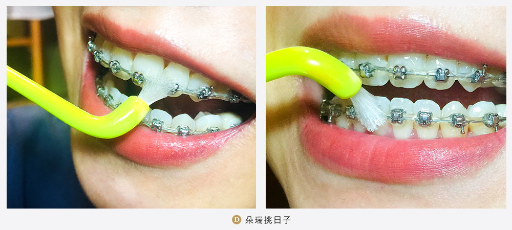 牙套心得 矯正牙齒清潔工具推薦 史上最詳細 分享我的潔牙技巧 朵瑞挑日子
