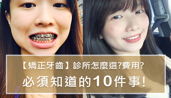 矯正心得 整牙費用 診所怎麼選 後遺症 嘉安牙醫矯正心得分享 整牙前必須知道的１０件事 朵瑞挑日子