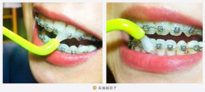 矯正牙齒清潔工具-單束毛牙刷