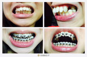 矯正牙齒