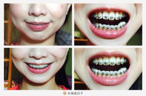矯正牙齒